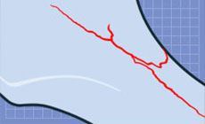 Cracked neck diagram